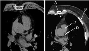 Cardiac Ct For Calcium Scoring