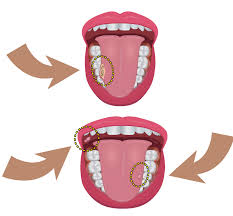 Image result for dental cancer