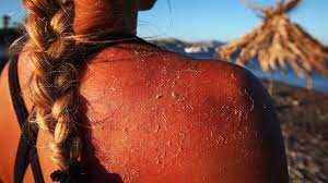 You have actually burned your skin. Skin Cancer And Sunburn Don T Fry Day Promotes Sun Safety