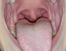 Streptolysin, an exotoxin, is the enzyme produced by the bacteria which. Streptococ Explore Facebook