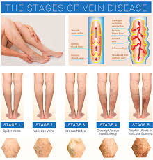 Does insurance cover varicose vein treatment?chronic venous insufficiency is a progressive disease that is covered by most insurance programs. Varicose Veins Treatment Vein Institute Of Pinellas Free Consultation