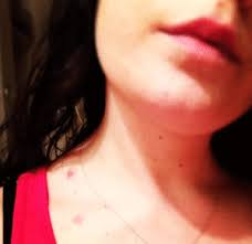 Feb 14, 2020 · hickeys can last as long as two weeks. The Best Ways To Eliminate A Hickey At Home Fastest Way To Make A Hickies Someone