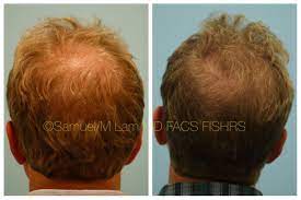 This 52 Year Old Man Is Shown Before And 6 Years After Crown Hair Transplant Hair Transplant Results Hair Transplant Procedure Crown Hairstyles