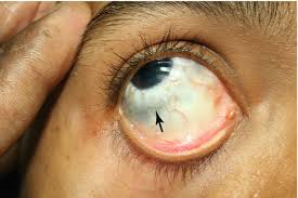 Image result for lesion sclera