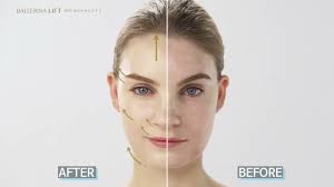 Scarlet S tratament facial radiofrecventa fractionata