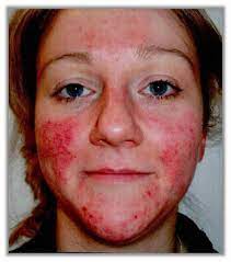 If you are looking for an organic option to help manage a rosacea flare up, look at dawn lorraine. How To Calm Rosacea And Reduce The Symptoms