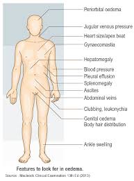 Image result for Localized Edema