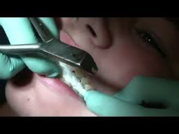 How and when can i expect to receive my itin? Watch How We Take Your Braces Off Youtube