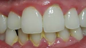 Angle the brush at 45 degrees so you can get bristles up into the corners between teeth and gums, where plaque can hide. How To Remove Tartar Using Kitchen Ingredients Mountainsofbeauty Youtube