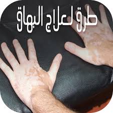 كيف تكون بداية البهاق vitiligo treatment vitiligo vitiligo cure