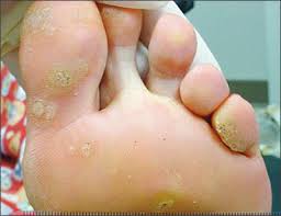Recalcitrant warts require a more aggressive and focused treatment approach. Cutaneous Warts An Evidence Based Approach To Therapy American Family Physician