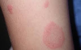 temre neden olur temre nasil gecer