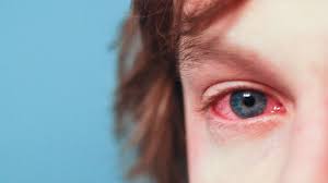 How to treat cat allergies. Cat Allergies Symptoms And Treatment