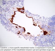 Pleura is composed of a simple squamous epithelium (mesothelium) overlying a layer of connective tissue that contains blood vessels and elastic fibers. Pathology Outlines Mesothelial