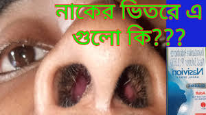 Topical corticosteroid nasal sprays reduce inflammation and edema in the nasal mucosa and may be beneficial as adjunctive therapy for acute bacterial sinusitis in both adults. Sinus Explaiment Bangla à¦› à¦‡à¦¨ à¦š à¦¥ à¦• à¦¦ à¦° à¦¥ à¦• à¦¨ Nasivion Adult Nasal Spray Youtube