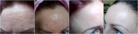Check spelling or type a new query. How Much Does Accutane Cost Accutane Cost Bongolife
