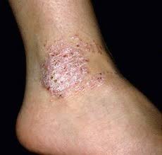 Image result for Lichen Simplex Chronicus