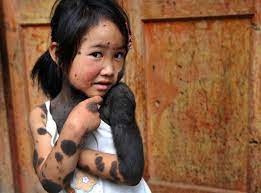 Furry Child: Chinese Girl's Body Covered by Black Spots & Fur [1200x889] :  rHumanPorn