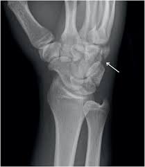 Image result for Wrist XRay