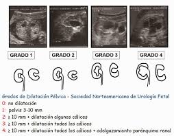 Maybe you would like to learn more about one of these? Ectasis Pielica Vertebrate Es Un Compromiso Trascendental Soldier El Bebe Rinon Dilatado Feto 33 Semanas