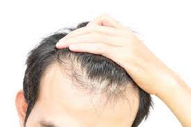 Maybe you would like to learn more about one of these? Garis Rambut Mundur Di Sekitar Dahi Tanda Anda Mulai Botak