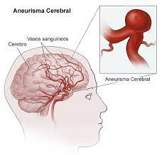 O aneurisma é uma área frágil na parede de um vaso sanguíneo que se torna uma protuberância e pode aumentar de tamanho. Cerebral Aneurysm