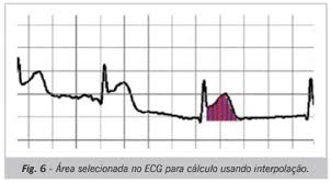 Para assinalar o dia mundial do coração, a associação portuguesa de intervenção cardiovascular (apic) e a delta cafés vão divulgar os sintomas de alarme para o enfarte agudo do miocárdio, nos pacotes de açúcar, distribuídos em todo o país, durante o mês de setembro. Scielo Brasil Analise De Registros Eletrocardiograficos Associados Ao Infarto Agudo Do Miocardio Analise De Registros Eletrocardiograficos Associados Ao Infarto Agudo Do Miocardio