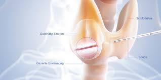 Schmeding in der klinik für chirurgie und sektionsleiter der endokrinen. Https Xn 123schilddrse 6ob De Index Php Therapie Radiofrequenzablation Rfa