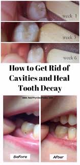 How To Get Rid Of Cavities And Heal Tooth Decay Heal Cavities Dental Cavities Teeth Health