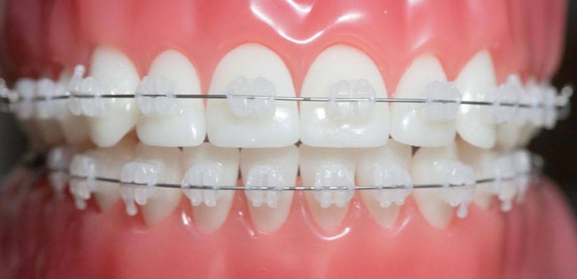 CERAMIC BRACES product image