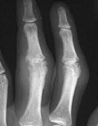 Image result for XRay Changes in Rheumatic Conditions