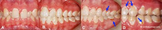 Fabriquer un appareil à laser qui réduit les caries. Les Appareils Orthodontiques Et La Carie Dentaire Bucco