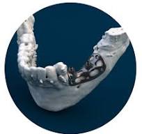 Implantes customizados | Phibo