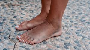 Image result for brown patches on the feet