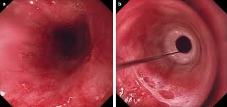 Image result for Proctitis