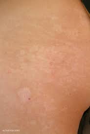 Authoritative facts from dermnet new zealand. Pityriasis Versicolor Overview Altmeyers Encyclopedia Department Dermatology