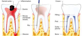 A root canal is a procedure used to preserve a tooth that has suffered deep decay, infection, or trauma. How Long After A Root Canal Should You Get A Crown Quora