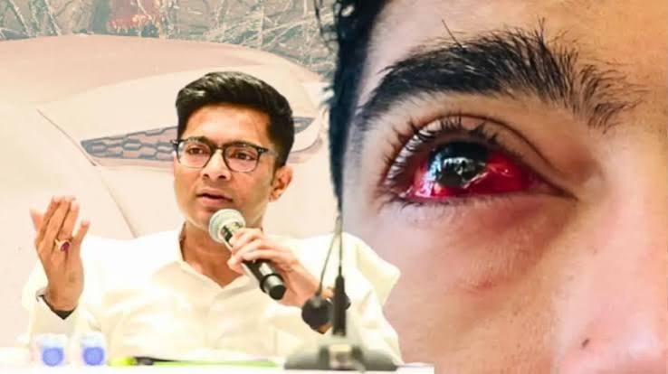 Abhishek Banerjee treatment update know about his eye treatment surgery