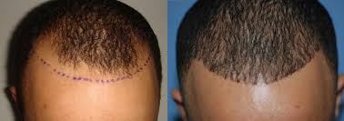 Black men usually have thick hair and a lot of effort is put in while we style them. African American Hair Transplant In Miami Care4hair