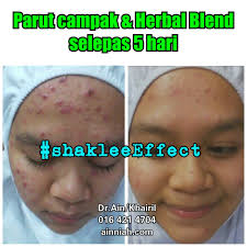 Muka pun bersih tanpa parut parut. Parut Chicken Pox Hilang Dengan Shaklee Iejaibrahim