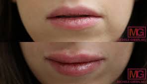 Patient profile age 21 area of face treated lips product used juvederm ultra plus amount of product used 1 ml. Before After Juvederm Photos Juvederm Voluma Volbella Vollure And Fillers