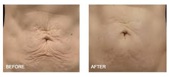 HIFU Skin Tightening Treatment Sydney | Non Surgical Face Lift | Skin Body Health