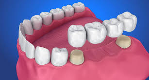 See full list on wikihow.com How To Floss A Dental Bridge Mint Dental