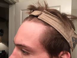 Many hair tonics promise to regrow thinning hair. Advice For Balding In Early 20s Hairlosstalk Forums