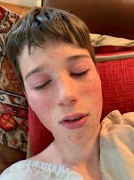 What causes contact dermatitis from gardening and how to find relief?