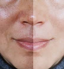 Image result for Q Switched ND: YAG For Melasma
