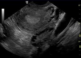 If you experience symptoms of polycystic ovary syndrome (pcos), they'll usually become apparent in your late teens or early 20s. Pco Syndrom So Behandeln Sie Es Richtig