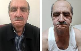 The Laryngoscope: Vol 134, No 7