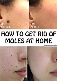 Natural Remedy To Remove Moles At Home Overnight Skinmarks Skinmole Skinpigmentation Skintags Moler In 2020 How To Get Rid Health And Fitness Articles Skin Moles