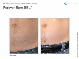 The avante laser training institute is the top laser training school in the woodlands / houston area. Laser Hair Removal Fort Lauderdale